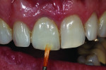 Figure 30 Custom staining was applied
externally to incisal one-third.