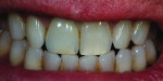 Figure 34 The teeth were dehydrated, allowing match to be uncertain.