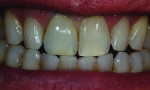 Figure 35 Hydration of the teeth made a big
difference to confirm a harmonious match.