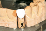 Figure 12  Overextension of incisal porcelain to compensate for shrinkage during firing.