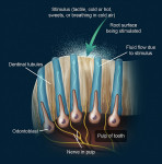 Figure 1  The hydrodynamic theory describes the aspiration of odontoblasts into the dentinal tubules as an immediate effect of physical stimuli to exposed open-ended tubules.