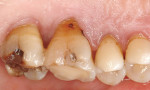 Figure 2b  Gingival recession with exposed root surfaces are susceptible to dentinal hypersensitivity. (B) Example of exposed lingual surfaces.