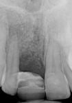 Figure 2. Radiograph showing the loss of periodontal attachment on the mesial aspect of tooth No. 7. A bone graft was placed when the implant was removed.