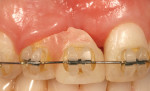Figure 4. A fixed orthodontic appliance was placed and the interproximal tissues were moved to be more incisal, as was the midfacial on tooth No. 7, which is negotiated through crown lengthening after tooth movement was complete. The pink acrylic was
removed as the tooth relocated.



lengthening after tooth
movement was complete.