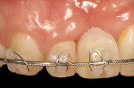 Figure 5. After completed forced eruption, tooth No. 7 was stabilized for 6 months. All the pink acrylic was eventually removed and the mesial papilla was now coincident with that of tooth No. 9.