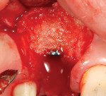 Figure 7. A bone allograft was placed to augment the labial aspect of ridge No. 8 during simultaneous implant placement.