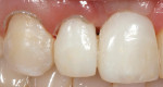 Figure 10. After a few weeks of healing of the soft tissues after non-surgical tissue sculpting, a gingivectomy was done to re-shape the gingival zenith and levels of teeth Nos. 6 through 8.