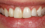 Figure 11. The smile of the patient in provisional restorations tooth No. 7 and implant No. 8 after correction and healing of the periodontium.