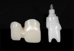 Figure 12. An all-ceramic custom CAD/CAM–fabricated abutment was made for implant No. 8 and splinted crowns for tooth No. 7 joined to implant No. 8. The splinted zirconium dioxide framework is shown.