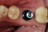 Fig 6. A clinical view of this area suggests that peri-implant mucositis is present. The tissue is swollen, it bleeds on probing, has 5 mm of probing depth, and exhibits purulent exudate.