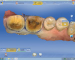 Figure 3 CEREC Omnicam scan of the prepped teeth No. 18 and No. 19.