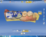 Figure 5 Proposed restorations on teeth No. 18 and No. 19 by the 4.0 software on the CEREC Omnicam.