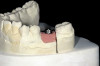 Fig 8. Radiograph taken 3 years after restoration of this mandibular right second molar implant demonstrating a peri-implant lesion.