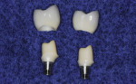 Figure 9 CAD/CAM milled zirconia abutments fabricated with metal connector insert, upon which zirconia CAD/CAM milled crowns have been fabricated.