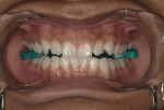 Figure 2 Patient with lip balm on, cheek retractors in, and IsoBlock in place.