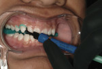Figure 3 Light-cure gingival barrier placed to protect the gingival tissue during the bleaching process.