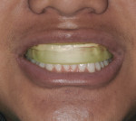 Figure 6 Prefilled tray with potassium nitrate and
fluoride placed by assistant at end of in-office bleaching treatment (Ultra-EZ prefilled
tray, Ultradent Products).