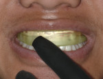 Figure 7 Prefilled tray was gently adapted to teeth.