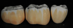 Gingival and dentin color infiltration liquids were applied to the green stage zirconia restorations.