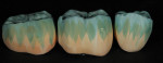Incisal “grey-blue” color infiltration liquids were then applied to the restorations.