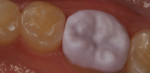 Try-in of a milled lithium metasilicate restoration prior to final crystallization.