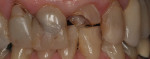Pre-operative frontal view of severely broken down central incisors.