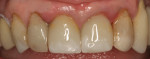 Post-operative view of milled lithium disilicate restorations placed on the same day appointment.