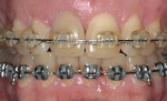 Figure 1a  Patient presentation 18 months into orthodontic treatment.