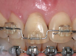 Figure 1b  Orthodontic extrusion in progress.