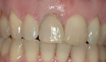 Figure 1d  Postorthodontic presentation before extraction.