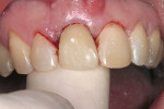 Figure 1f  After implant and temporary abutment placement, a temporary is fabricated and cemented into place.