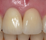 Figure 1i  Completed restoration close-up showing excellent soft tissue profile.