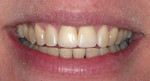 Figure 1j  Completed view of smile.