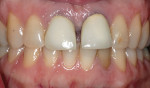 Figure 2b  Retracted view of hopeless central incisors.
