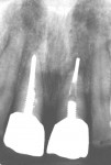 Figure 2c  Radiographic appearance of hopeless central incisors.