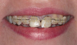 Figure 2d  Orthodontic extrusion of both central incisors.