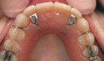 Figure 2g  Occlusal view of removable temporary prosthesis. Note definitive occlusal stops.