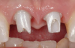 Figure 2j  Ceramic abutments in place. Note excellent soft tissue profile and papilla retention.