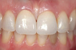 Figure 2k  Close-up view of final Procera® crowns.