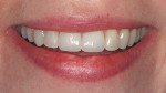 Figure 2l  Smile view of completed implant-supported crowns 1 month after insertion.