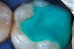 Figure 3  The preparation and occlusal surface are cleaned with 2% chlorhexidine.