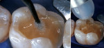 Figure 4a  A thin layer of single component adhesive was applied with an applicator tip in two separate coats: airthinned for 10 seconds