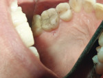 Figure 6 Case 2: An asymptomatic ulcerated lesion with raised borders located on the palate adjacent to tooth No. 14.