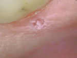 Figure 7 Case 2: Close-up view of the ulcerated lesion.
