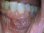 Figure 8 Case 3: Intraoral photograph of lesion on mucobuccal gingiva adjacent to tooth No. 22.