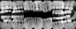 Figure 12 Postoperative full-mouth radiographs.