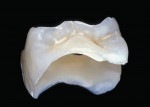 Figure 1  The indirect composite resin inlay providesmarginal integrity, wear resistance, and natural esthetics.