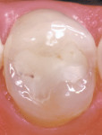 Figure 3a  Restoring a mandibular left second bicuspid with interproximal caries bold>(A) using a mesial-occlusal-distal Gradia™ (GC America, Alsip, IL) indirect micro-ceramic-composite restoration bold>(B).