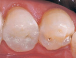 Figure 3b  Restoring a mandibular left second bicuspid with interproximal caries bold>(A) using a mesial-occlusal-distal Gradia™ (GC America, Alsip, IL) indirect micro-ceramic-composite restoration bold>(B).