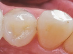 Figure 4  Replacing a defective amalgam restoration with recurrent decay on a mandibular left first bicuspid using a disto-occluso-lingual Sculpture<sup>®</sup> Plus (Pentron Laboratory Techologies,Wallingford, CT) nano-hybrid indirect composite